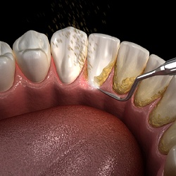Digital image of tartar being removed from bottom teeth