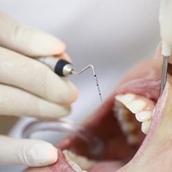 dentist performing a deep cleaning