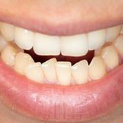 Close-up of smile with crowded teeth in lower arch