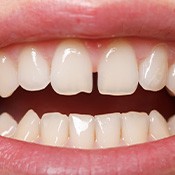 Close-up of smile with gap between upper teeth