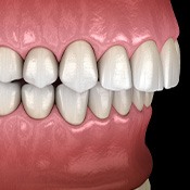Illustration of overbite viewed from the side