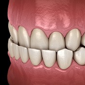 Illustration of underbite viewed at an angle