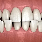 Illustration of a crossbite viewed from the front
