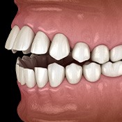 Illustration of an open bite viewed from the side