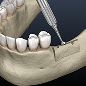 a digital illustration of a ridge expansion