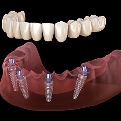 Illustration of All-on-4 for lower dental arch