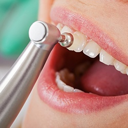 Woman having dental bonding procedure.