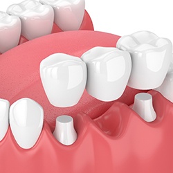 Illustration of dental bridge