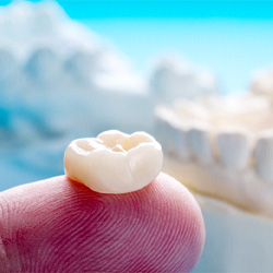 an example of dental crowns in Louisville