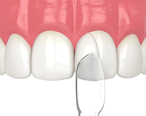 What is Dental Bonding?