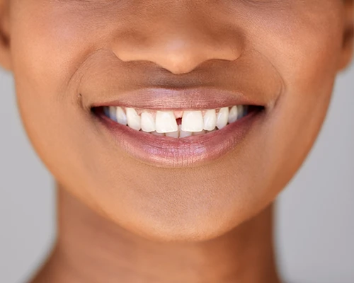 Is Dental Bonding Right for Me?
