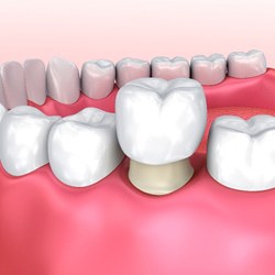Model of a dental crown on molar