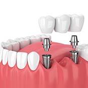 two dental implants with a dental bridge on top 