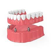 four dental implants supporting a full denture 