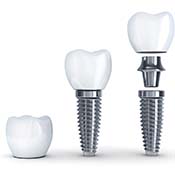dental implant post, abutment, and crown 