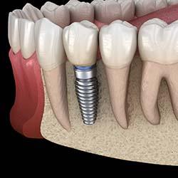 single dental implant in the jawbone 