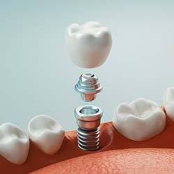 dental implant, abutment, and crown 