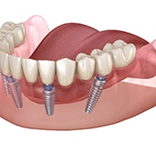 Four dental implants supporting dentures 