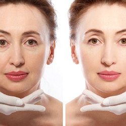 Before and after dermal fillers in Louisville