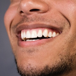 man smiling after gum recontouring in Louisville