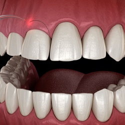 crown lengthening in Louisville