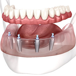 Dentist in Louisville showing a patient how implant dentures are placed