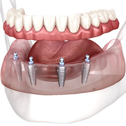 Dentist in louisville showing a patient how implant dentures are placed