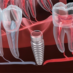 Illustration of a failed dental implant in Louisville, KY