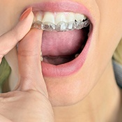woman putting Invisalign in her mouth