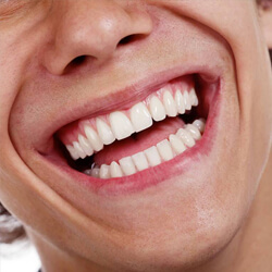 Close-up of a healthy smile