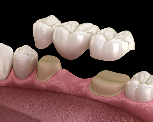 Dental Bridges