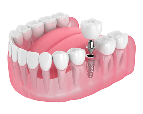 Dental Implants