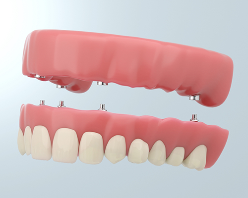 Dentures