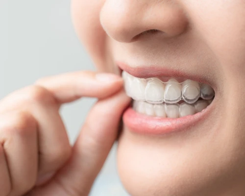 SureSmile Clear Aligners