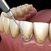 Digital illustration of scaling and root planing
