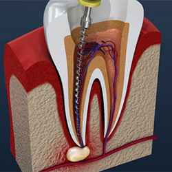 root canal