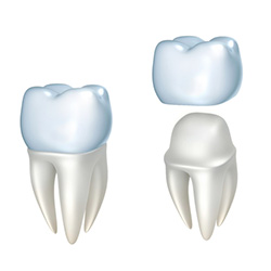 dental crown illustration