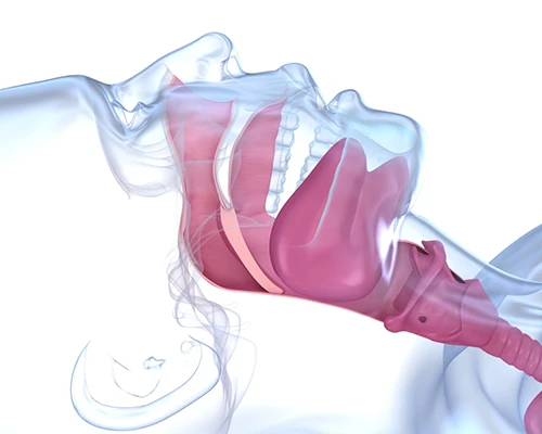 What is Sleep Apnea?
