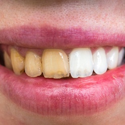 before and after teeth whitening