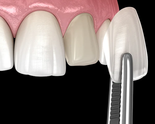 What are Dental Veneers?
