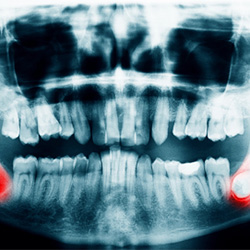 Problem wisdom teeth