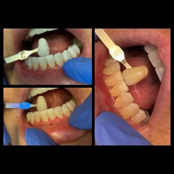 three side-by-side before and after Zoom! teeth whitening photos depicting teeth getting progressively brighter