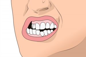 illustration of a person grinding their teeth