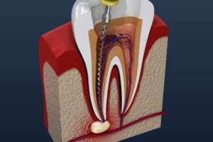 Infected tooth during root canal therapy. 