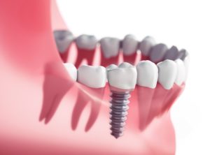 Dental implant for lower tooth