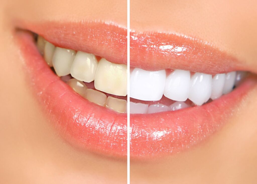 Closeup of a glossy smile that's half whitened