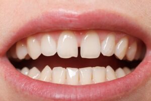 Close-up of smile showing gap between two front teeth.
